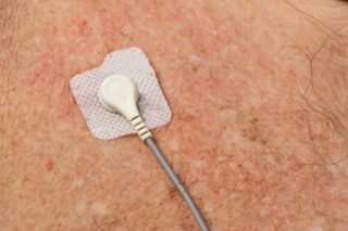 Phot d'un électrode ECG posé sur la peau
